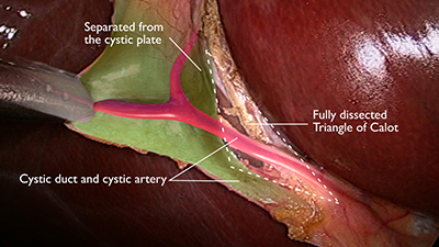 Calot’s Triangle And Rouviere’s Sulcus