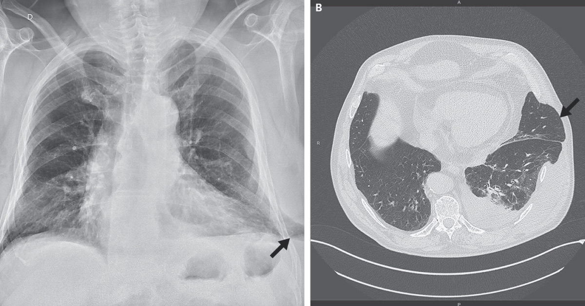 Spot The Condition From The Attached Radiograph And CT