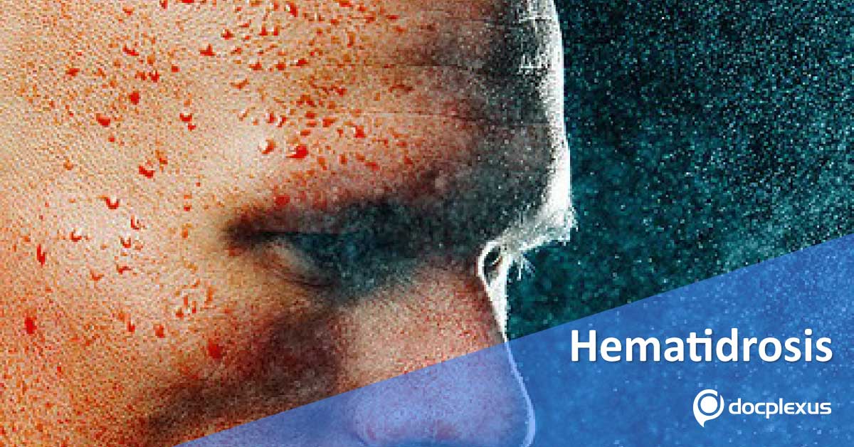 Hematidrosis, Causative Factors And Therapeutic Options