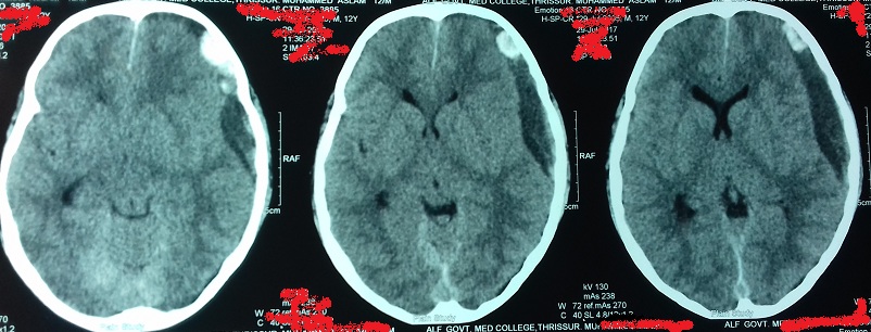 Case Of Headache