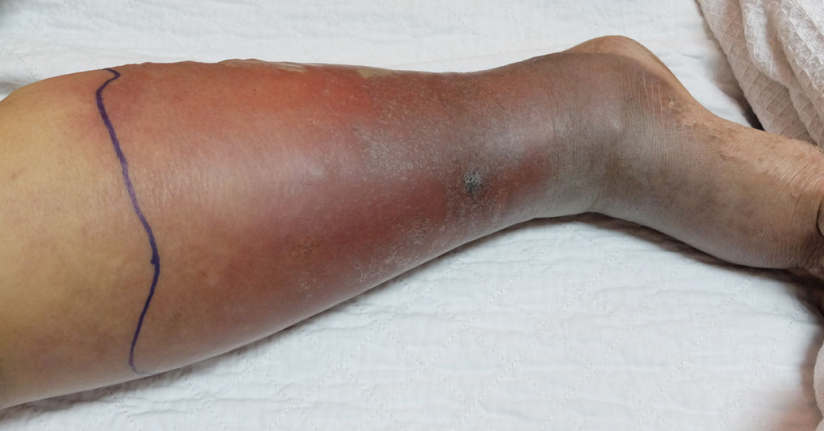 Management of Deep Vein Thrombosis In Trauma Patients