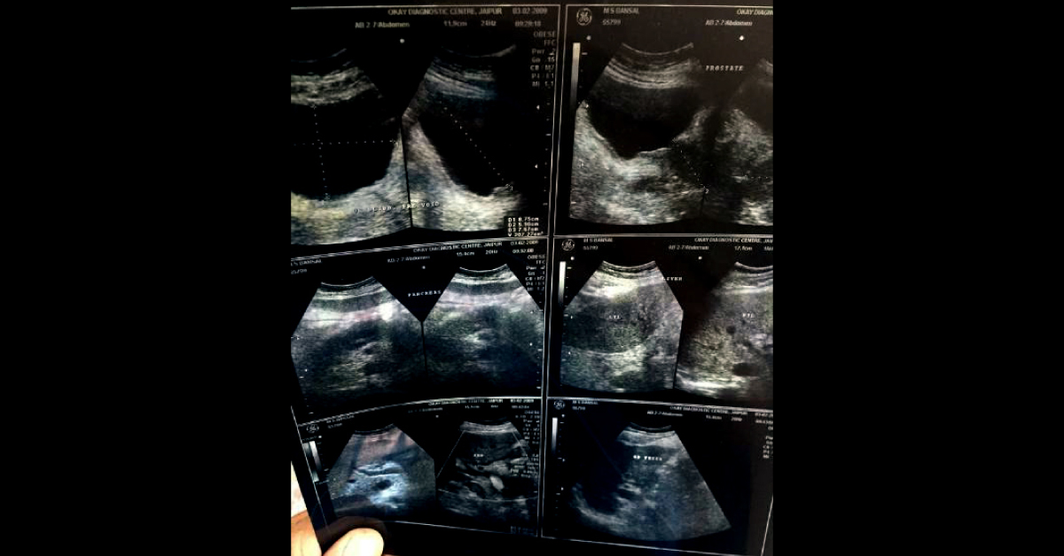 What Was In Pancreas Seven Years Ago?