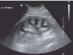Identify The Cause Of Elevating Creatinine