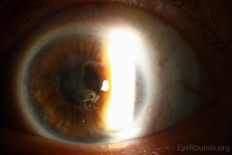 Solve This Ophthalmology Case
