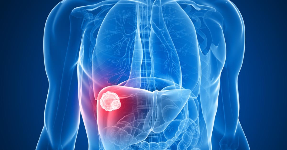 Hepatic Kaposi Sarcoma, An Insight
