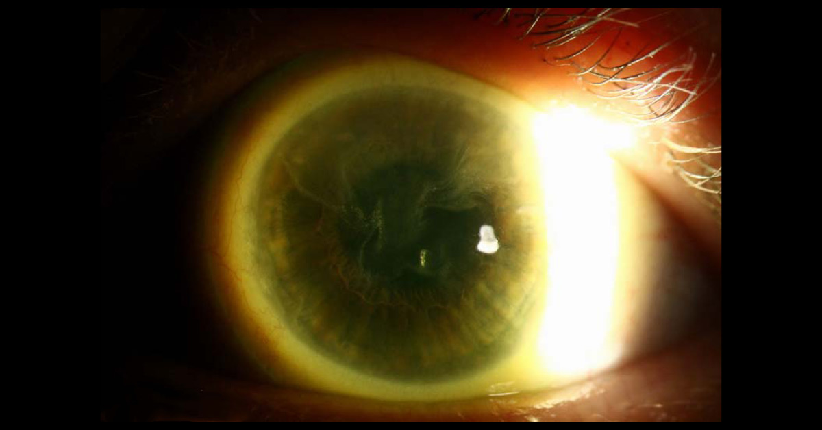 Diagnose The External Eye Disease
