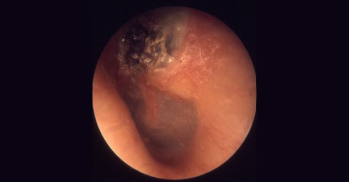 What Causes This Ear Discharge?