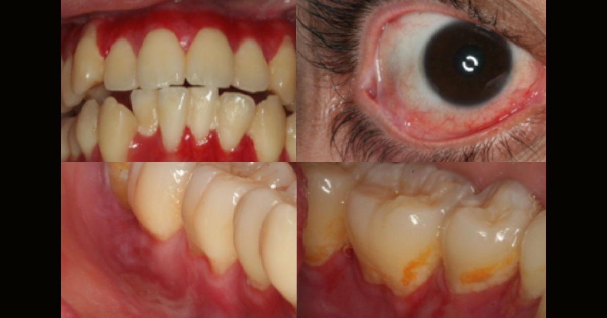 Diagnose The Oral Condition From Image
