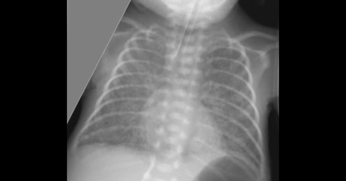 Why This Neonate Is In Respiratory Distress
