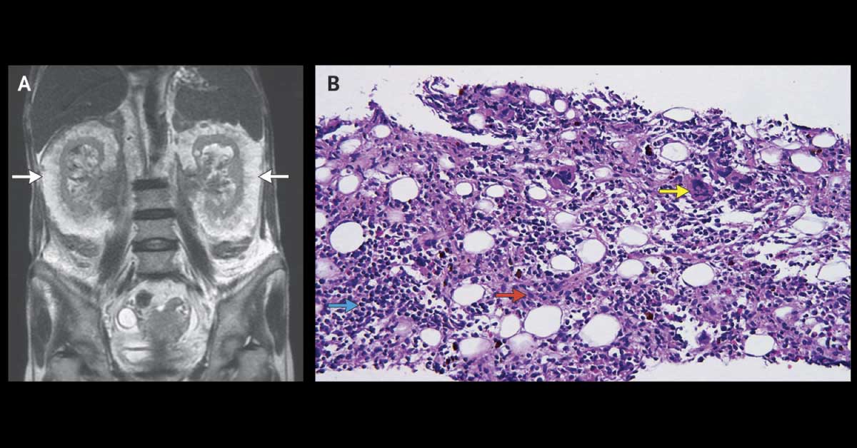 Identify This Condition In A CKD Patient