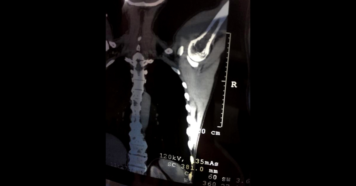 Silent Case Of Multiple Myeloma Or Something Else 