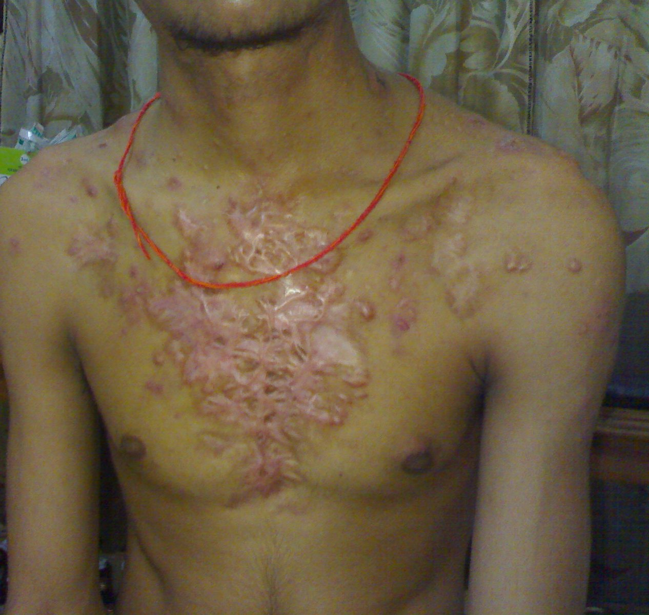 Identify The Dermalogical Condition
