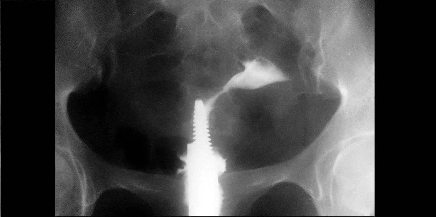 Management Of Bilateral Tubal Block At Cornua