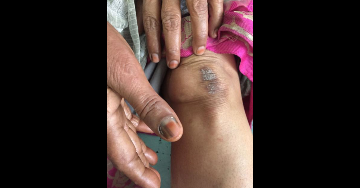What Are These Skin Lesions? 