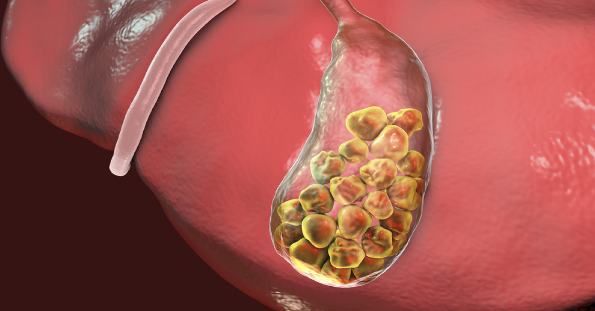Is Surgery Always Necessary for Gallstones