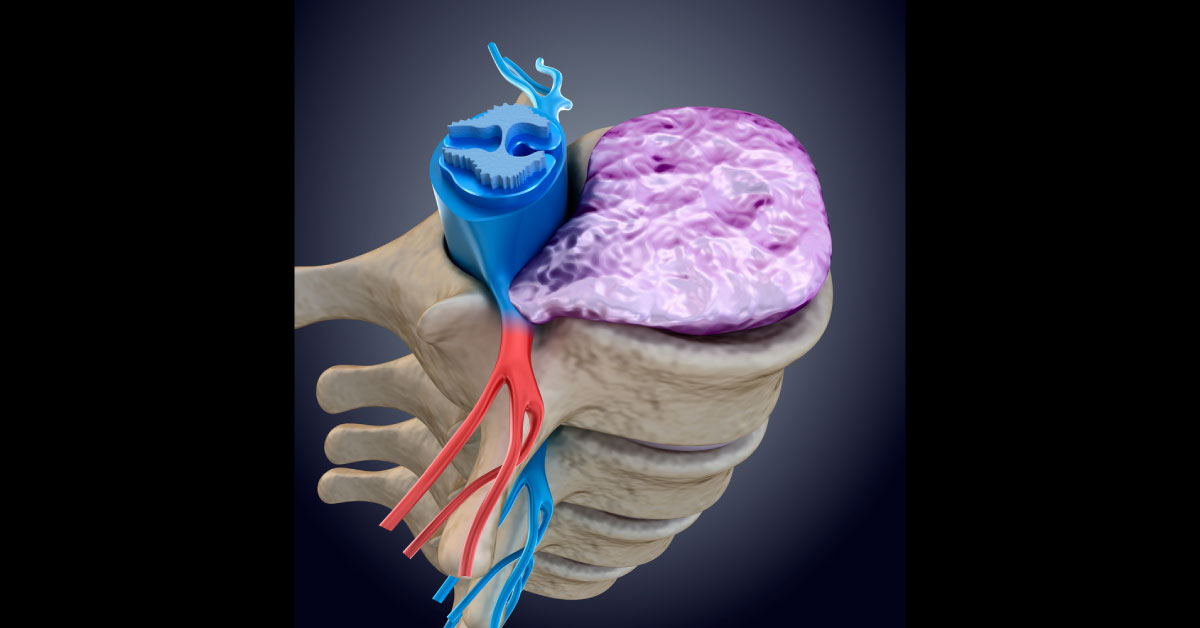 Biomarkers For Traumatic Spinal Cord Injury