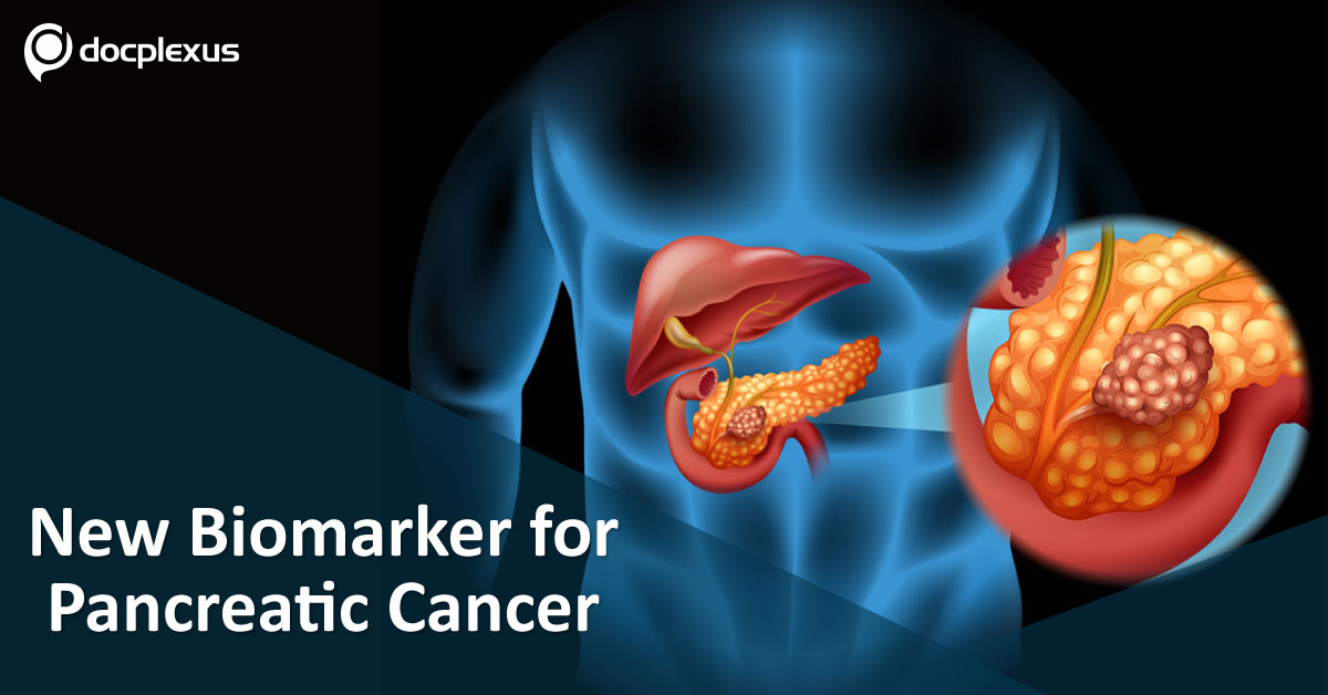 New Hope For Early Diagnosis Of Pancreatic Cancer