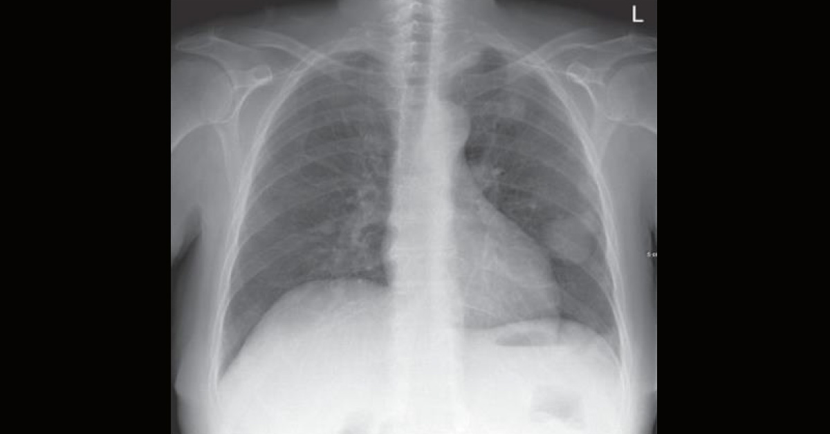 What Condition This Radiograph Reveals?