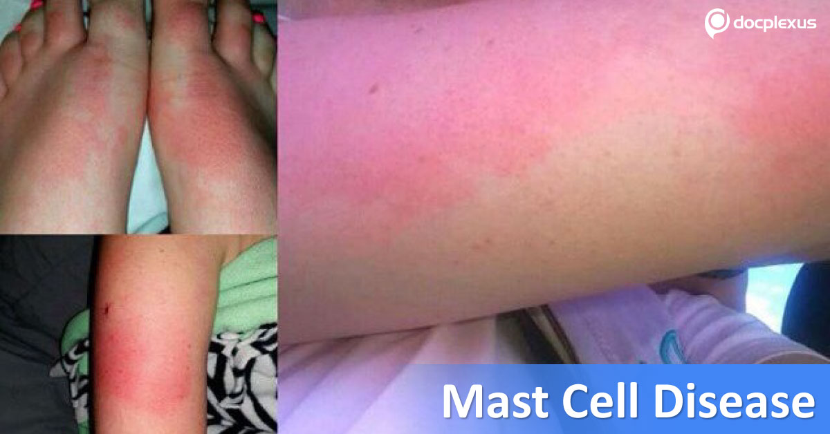 Mast Cell Activation Syndrome, Diagnostic Approach And Treatment