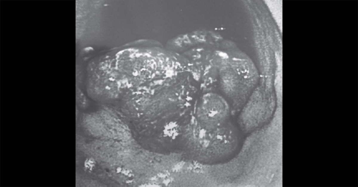 Rectal Cancer In A Septuagenarian