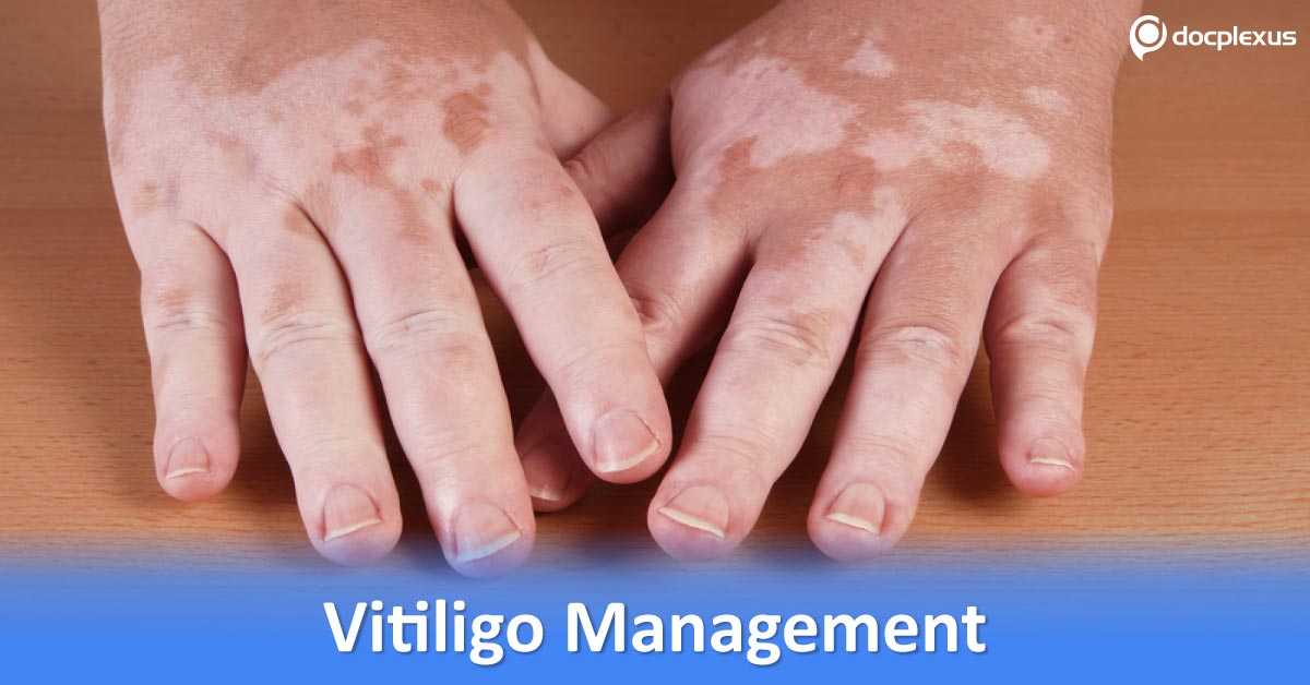 Considering Monobenzone For Extensive Vitiligo Management
