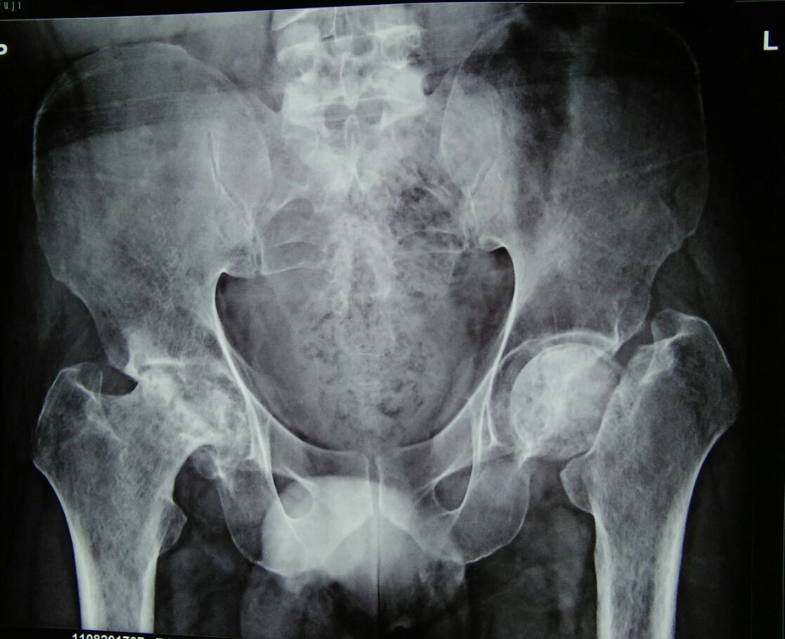 Uncontrolled Diabetic, Bedridden With Bilateral Hip Involvement