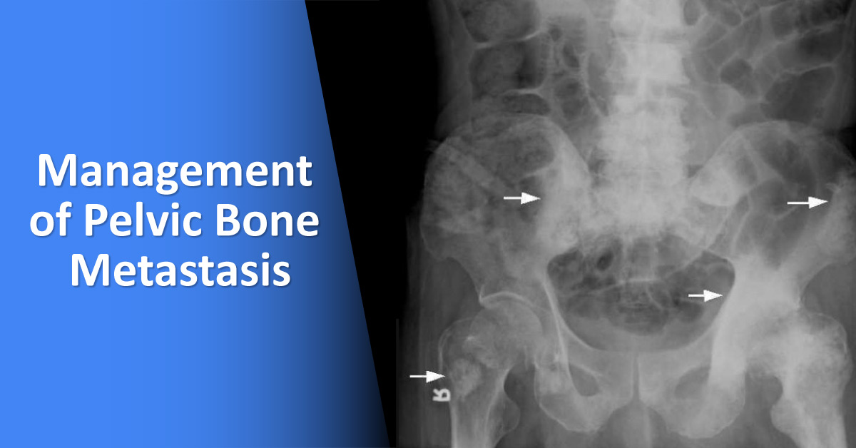 Surgical Management Of Pelvic Bone Metastases