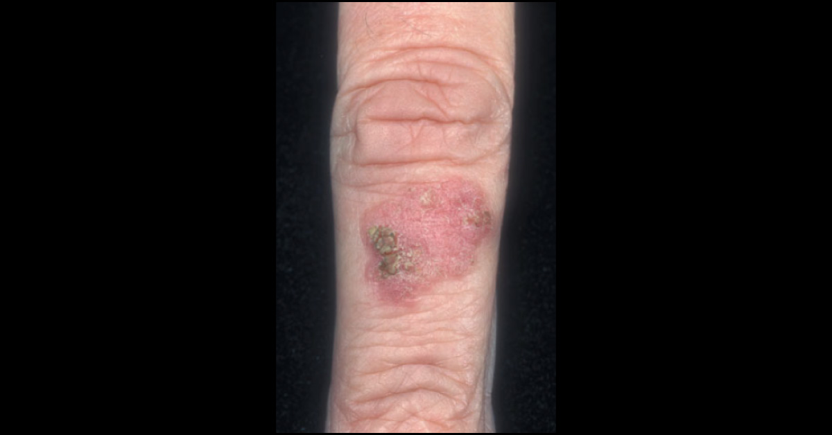 Identify This Finger Lesion