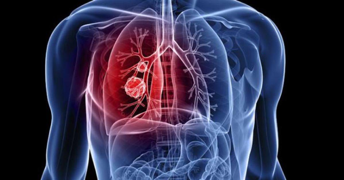 Gold Nanoparticles May Be Used To Treat Lung Cancer