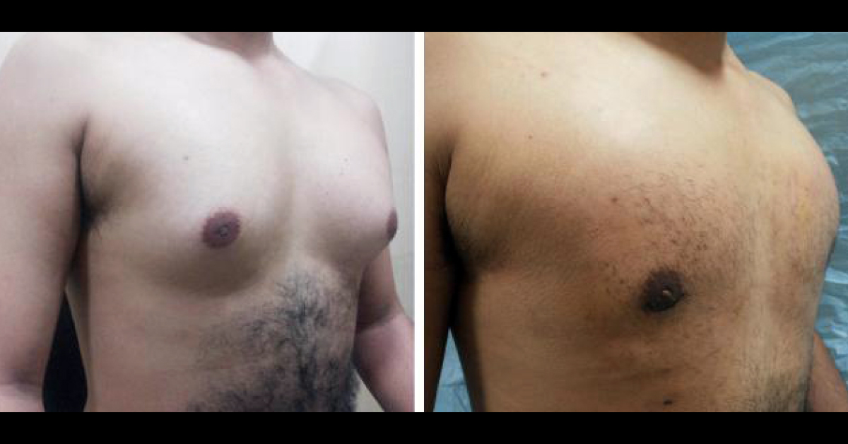 Gynaecomastia - One Of The Commonest Cosmetic Problem In Man