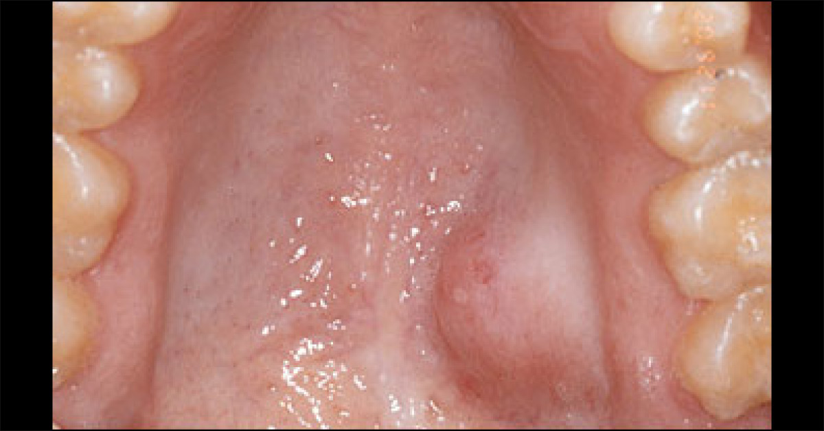 Case Of A Firm Palatal Nodule