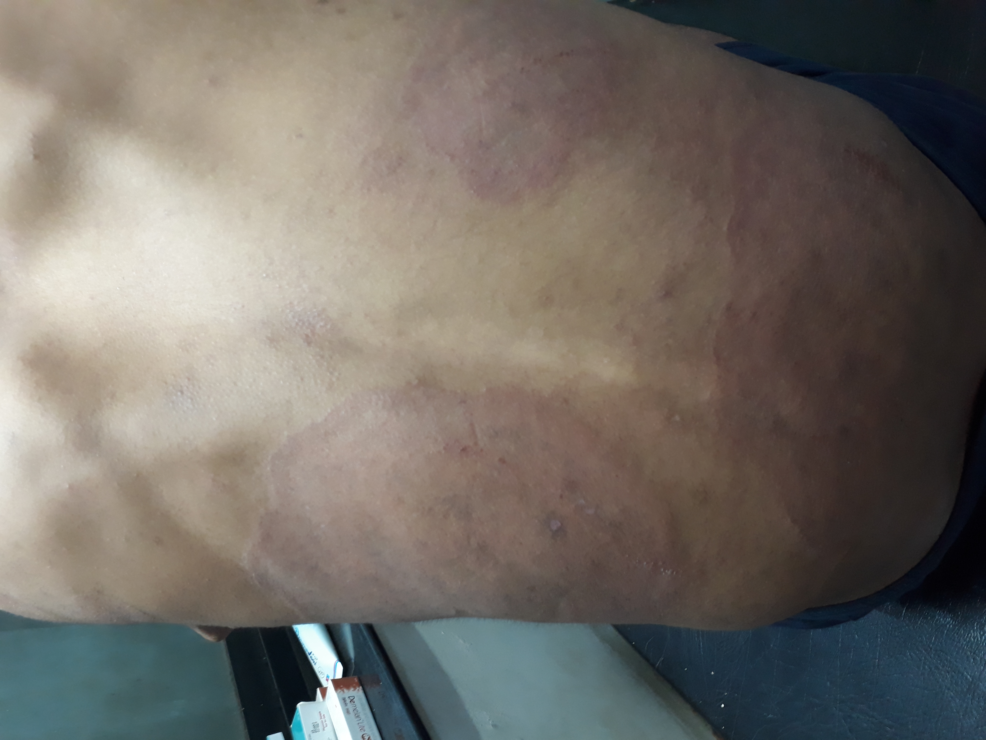 Resistant Case Of Fungal Infection
