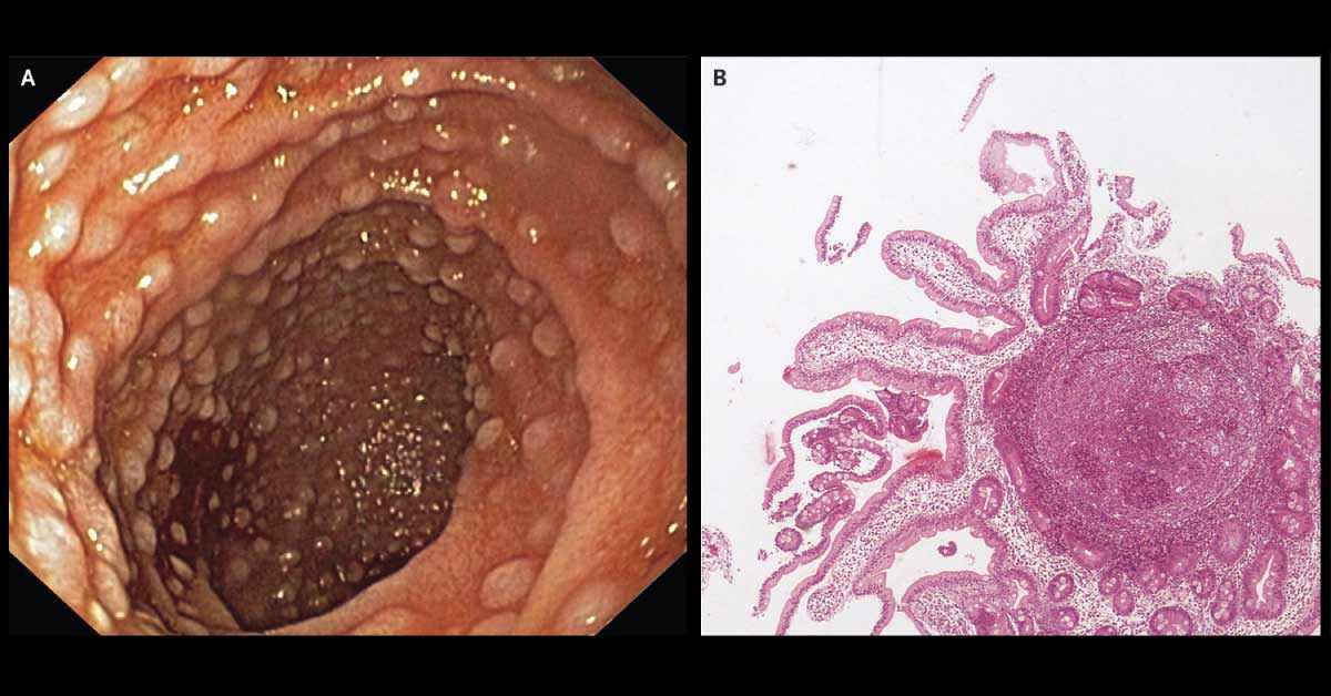 Spot This Condition In A Young Woman