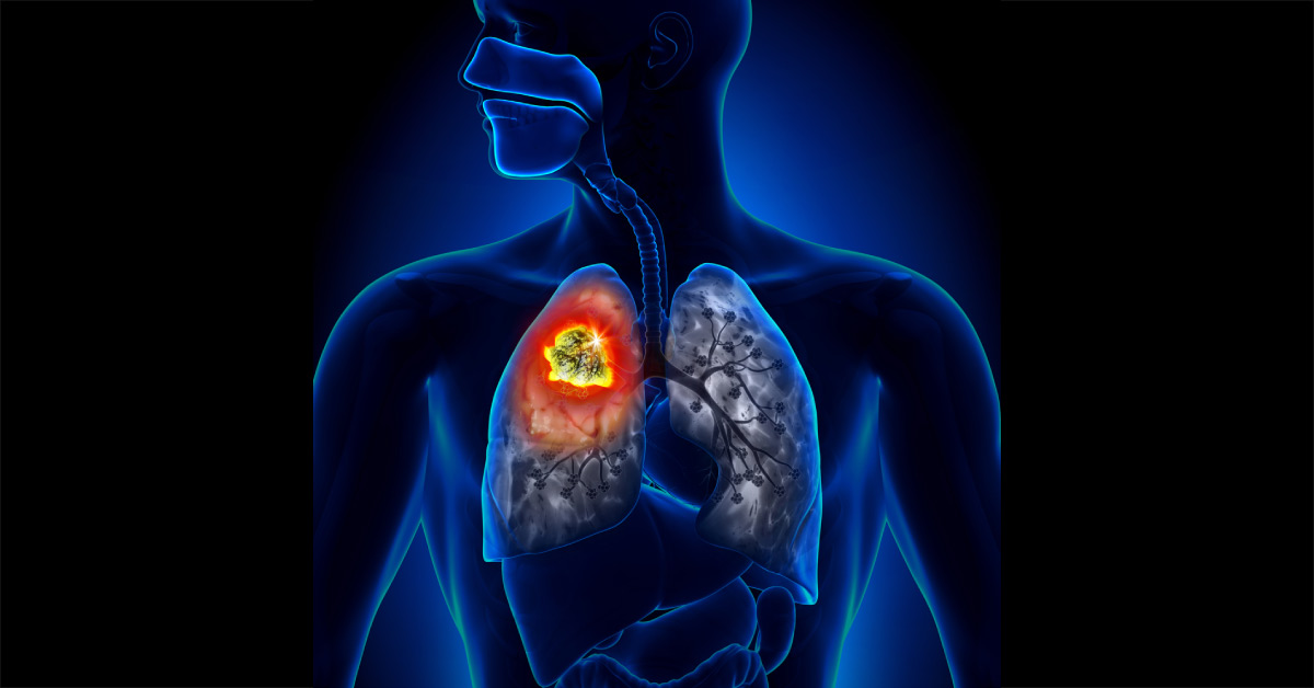 Non Small Cell Lung Cancer: Current Scenario