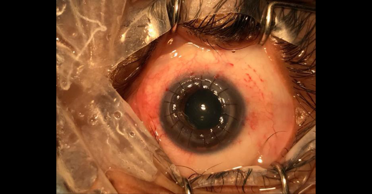 DALK In Extremely Thin Cornea