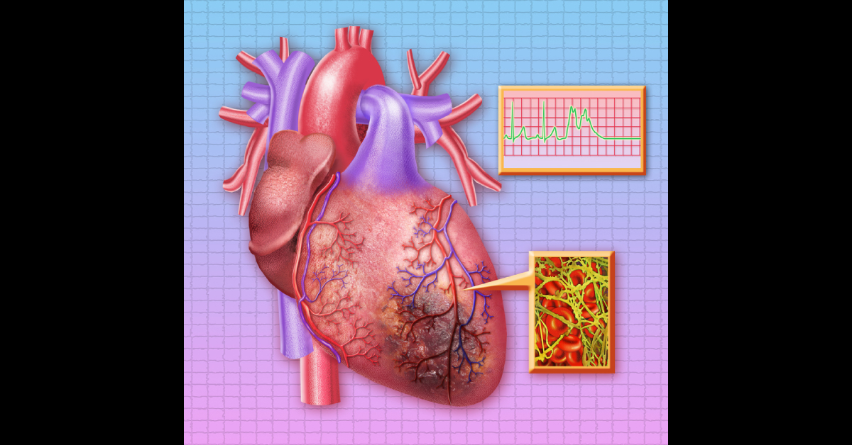 Rapid Algorithm To Diagnose Myocardial Infarction In Emergency