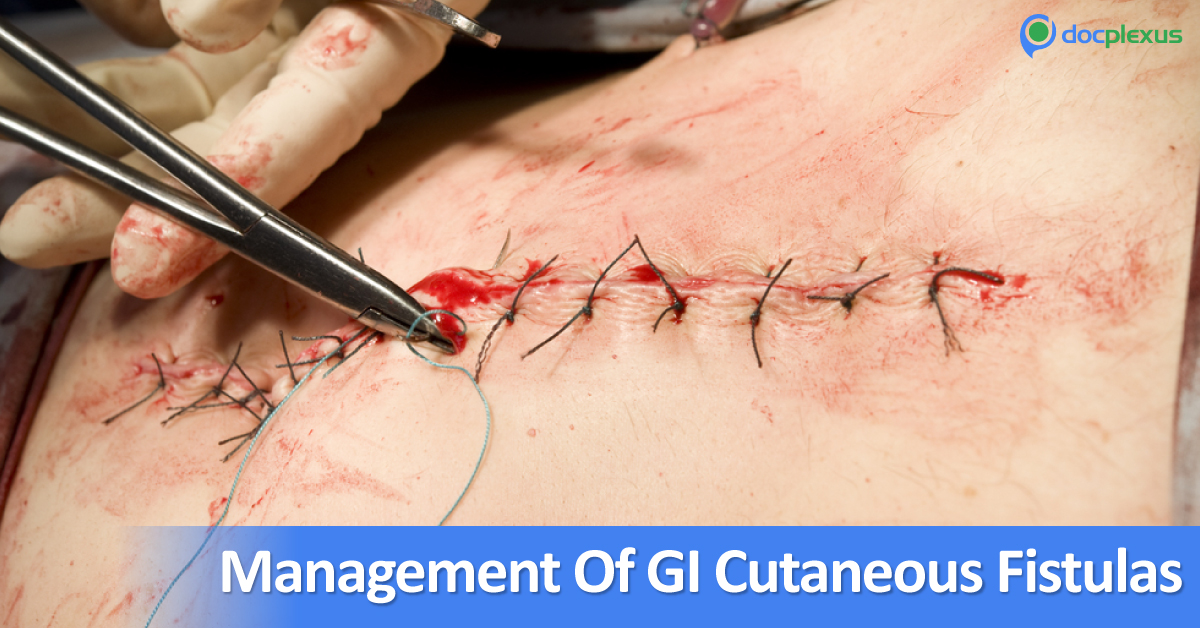 Management Of Gastrointestinal Cutaneous Fistulas