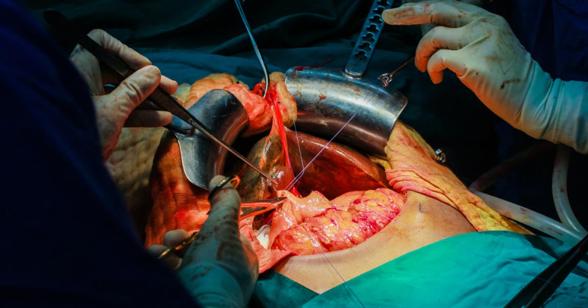 Immunosuppressive Therapy After Liver Transplantation