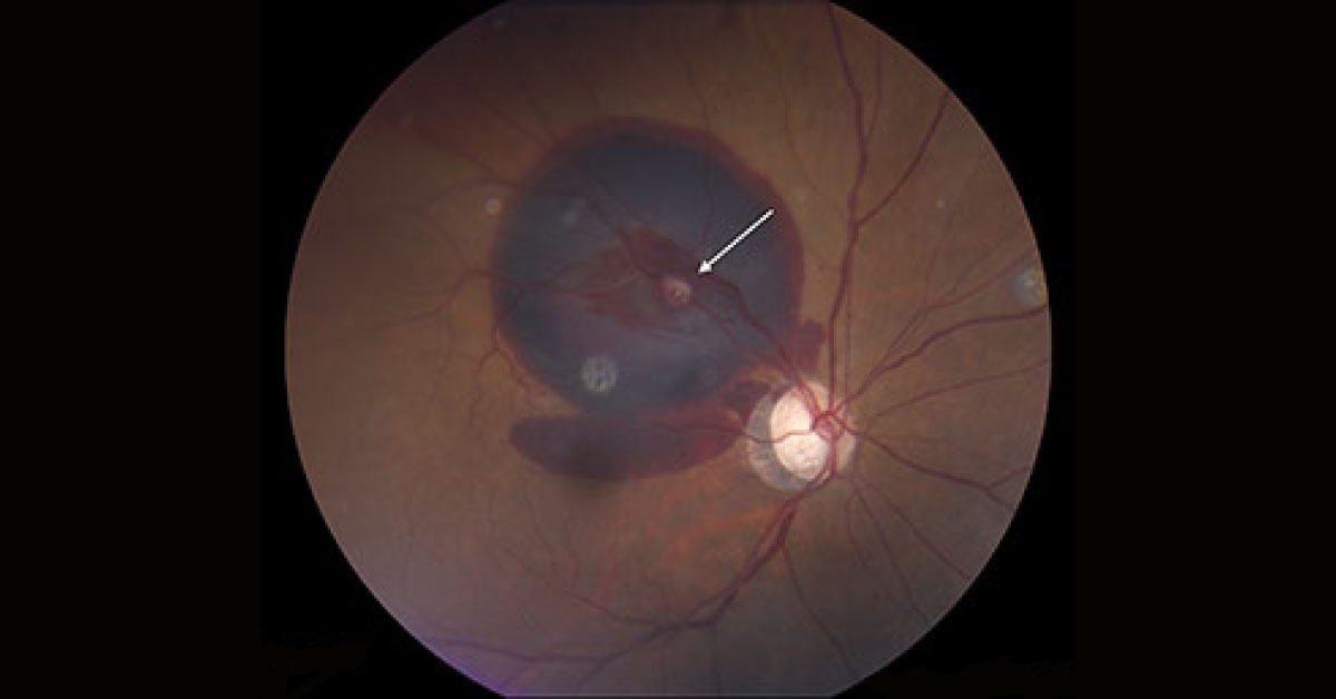Sudden Painless Decreased Vision In Right Eye