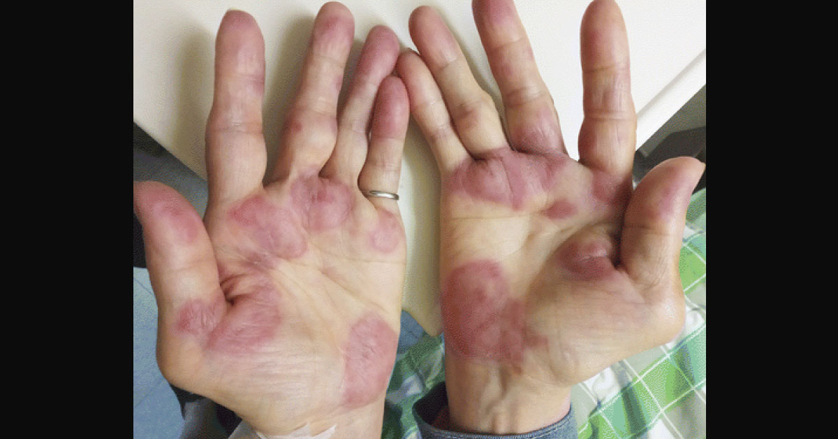Identify This Condition In A Rheumatoid Arthritis Patient