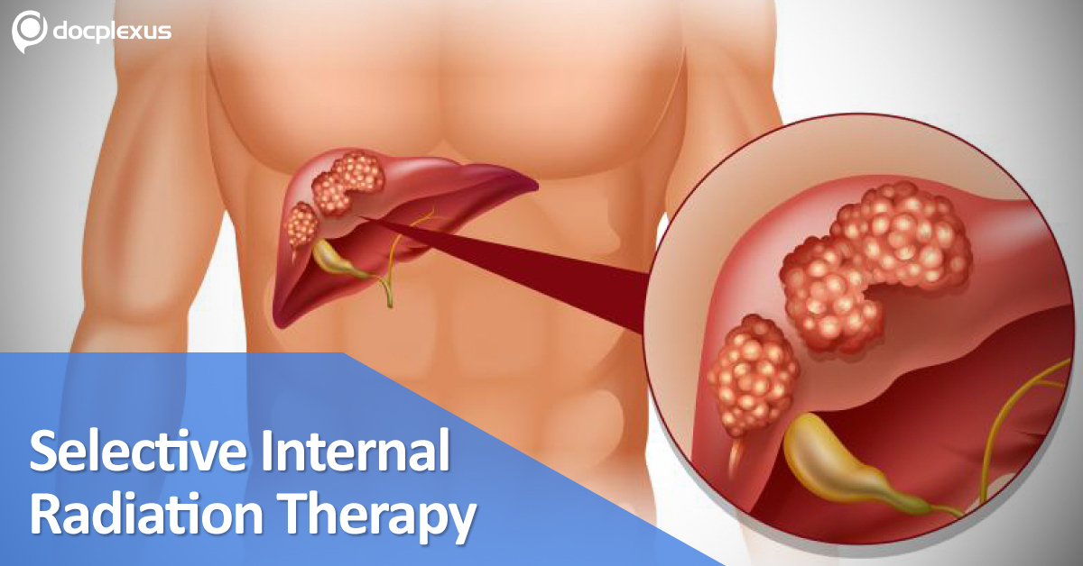 Intrahepatic Cholangiocarcinoma: The National Institute for Health and Care Excellence (2013)