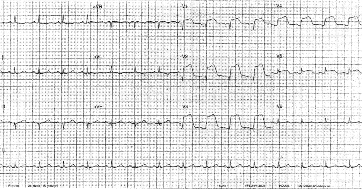 Interpret this ECG Finding