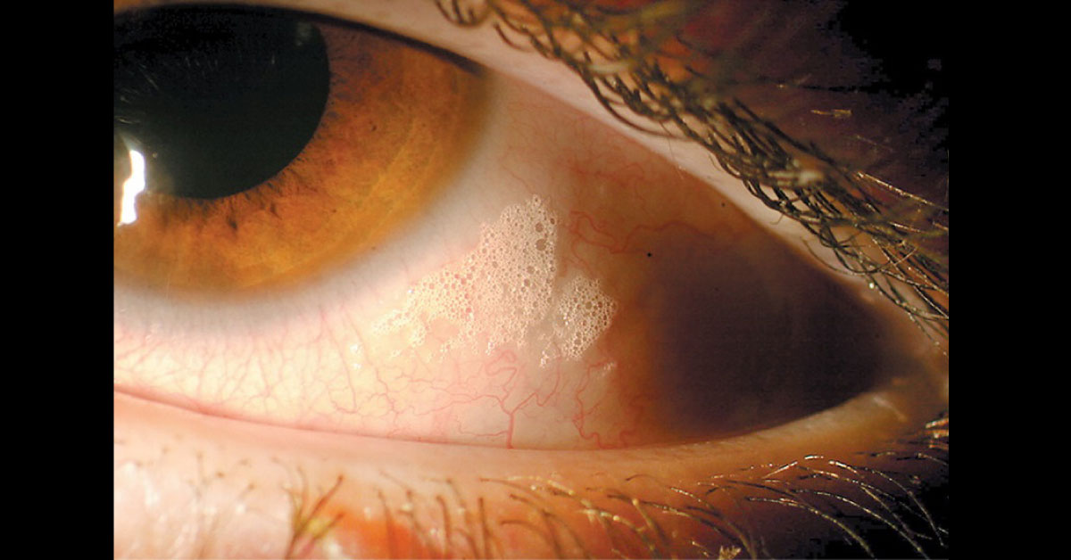 Identify This Condition In A Young Boy