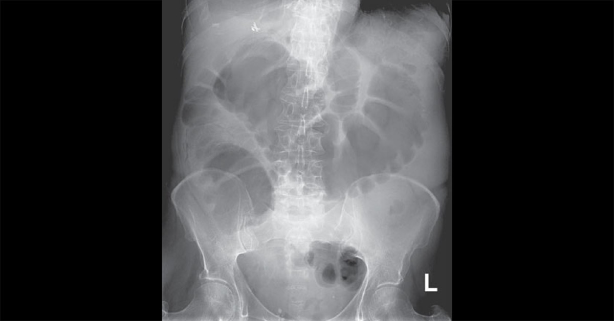 Interpret This Radiograph of Ovarian Cancer Patient