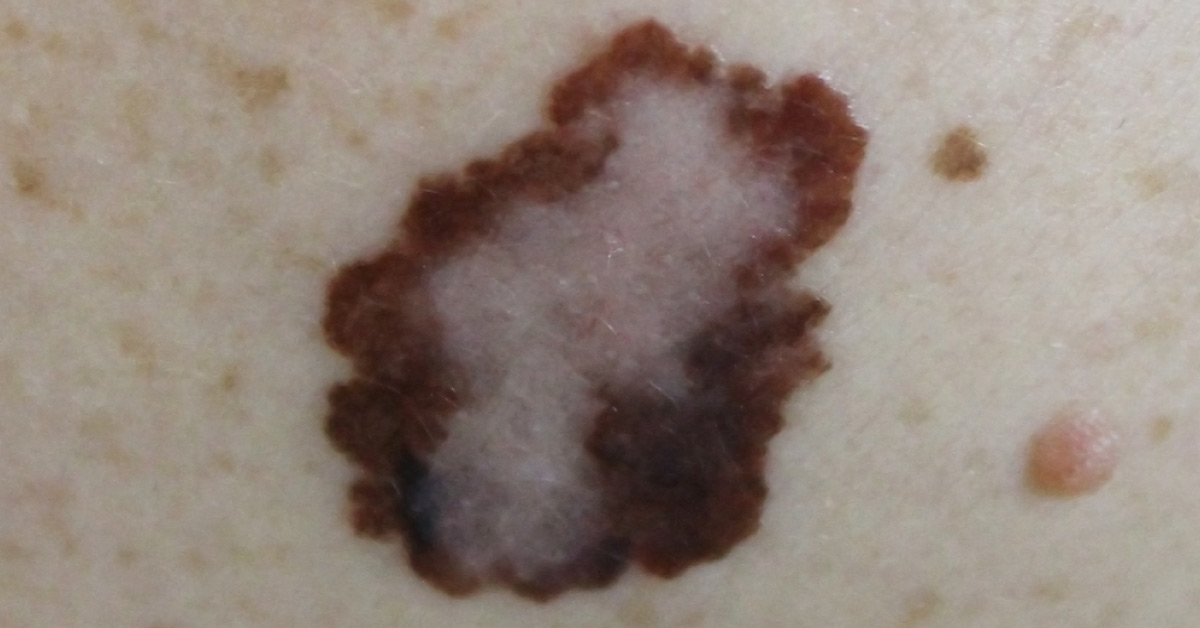 Cutaneous Melanoma: British Journal Of Dermatology (2010)