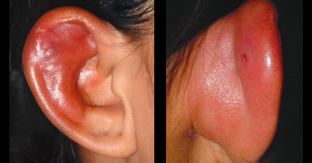 A Case Of Ear Piercing