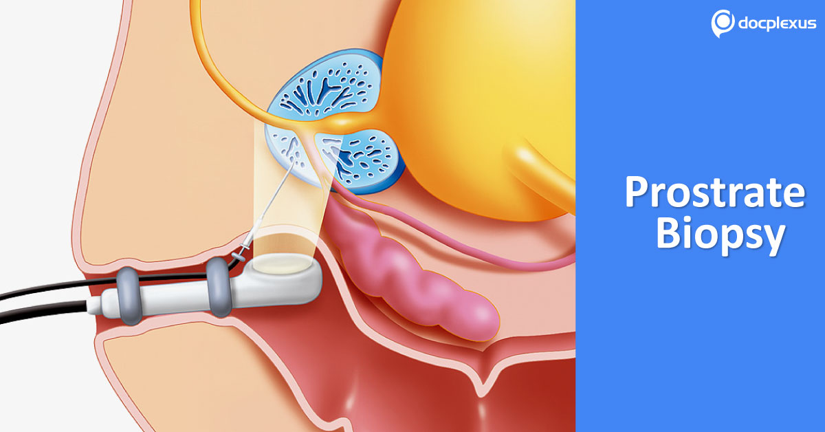 Practice Essentials To Avoid Common Complications Of Prostrate Biopsy In Hospital