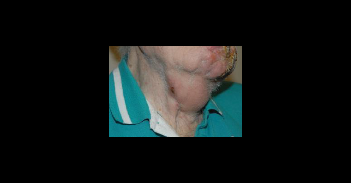 Case of Erythematous Lesion