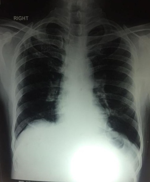 Is This Going To Turn Out To Be A Liver Abscess?