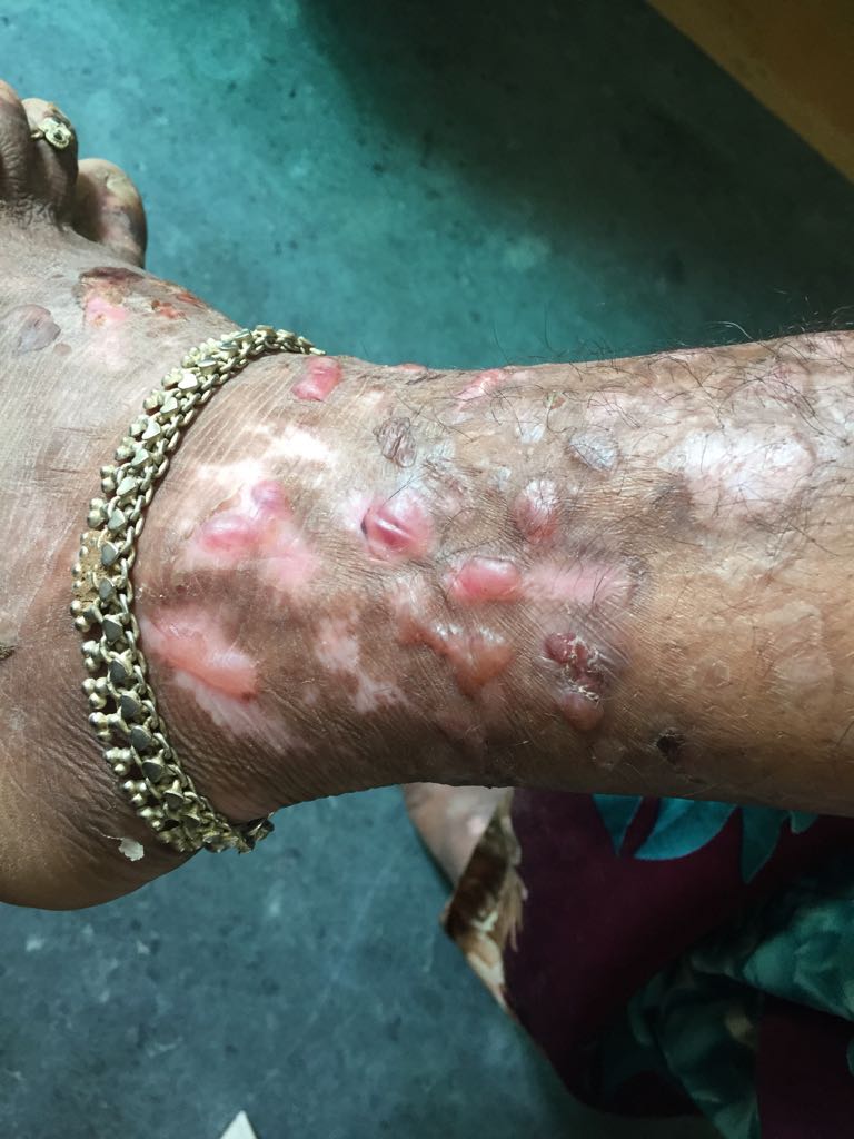 What Is This Skin Lesion?
